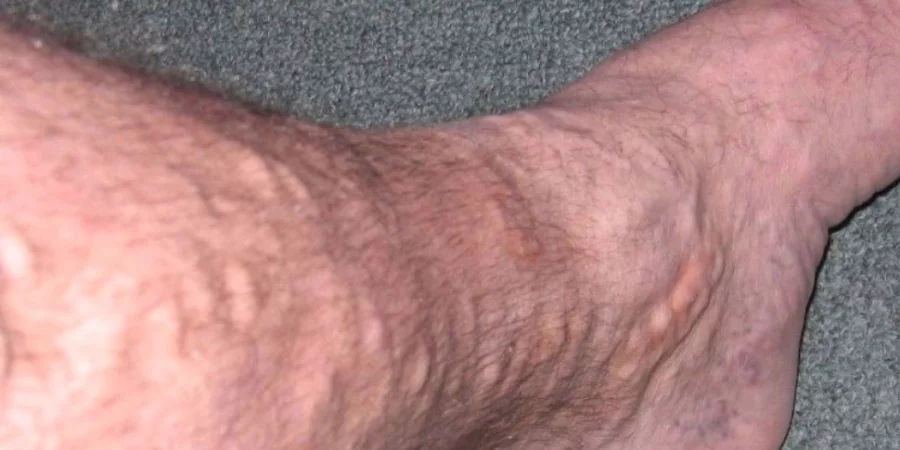 What Are Varicose Veins?