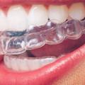 The Pros and Cons of the Six Month Smile Dental Treatment