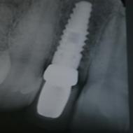Dental Implants FAQ: Everything You Need to Know About Dental Implants and Recovery
