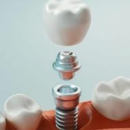 4 Tips And Tricks For Getting Dental Implants In Burlington
