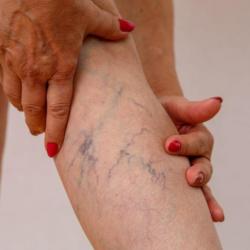 Spider Veins - Myths, Realities, and Potential Dangers
