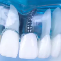 Dental Implant Solutions in Hungary