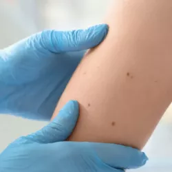 What Is Mohs Surgery and Why Is It Recommended?